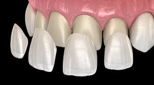 Exploring the Different Types of Veneers Available Today
