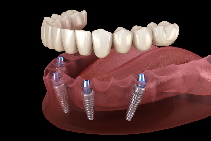 What to Expect When Getting Dental Implants