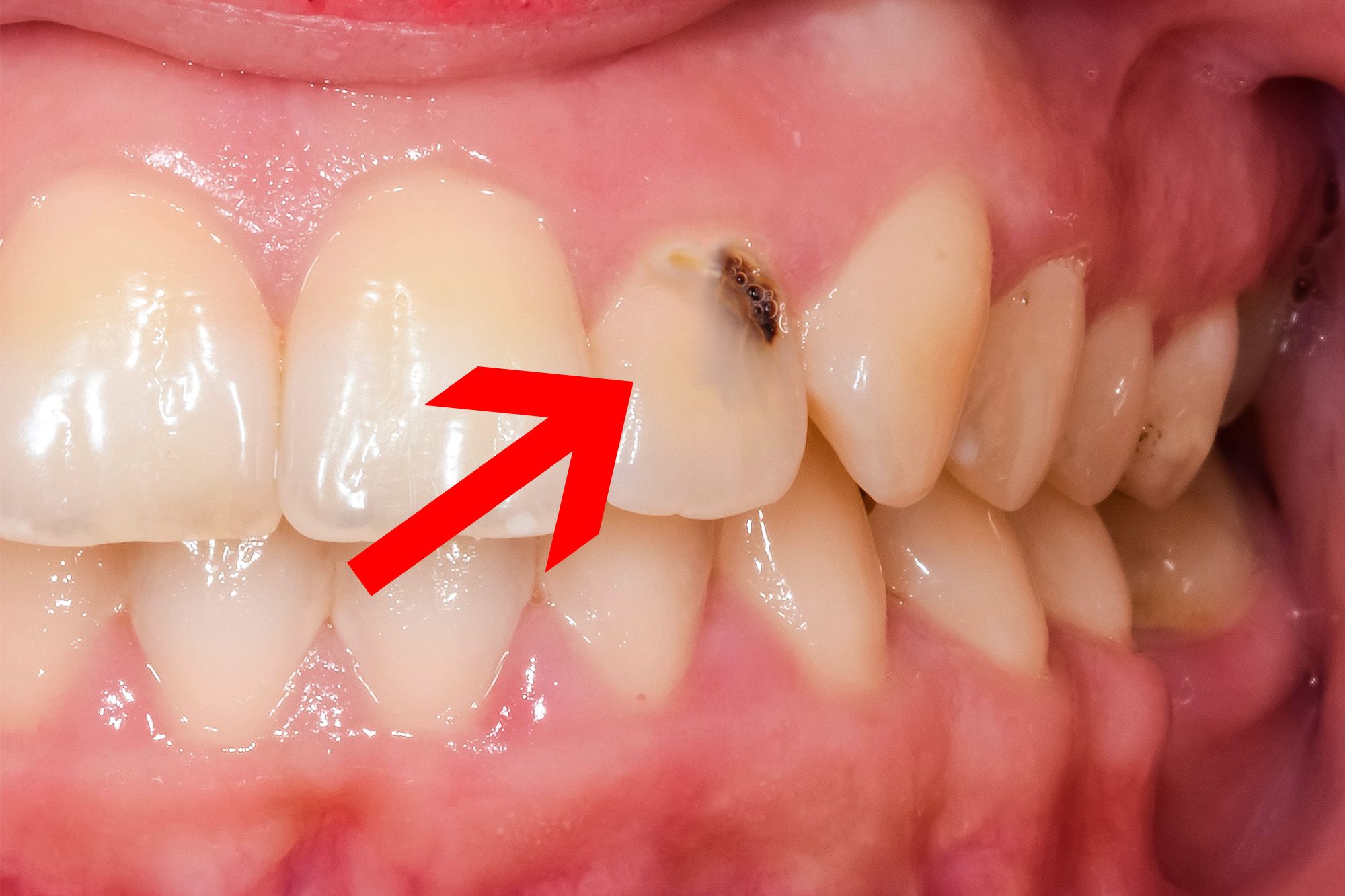 How a Dentist Can Help Prevent Cavities and Tooth Decay